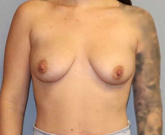 Breast Augmentation Before & After Image