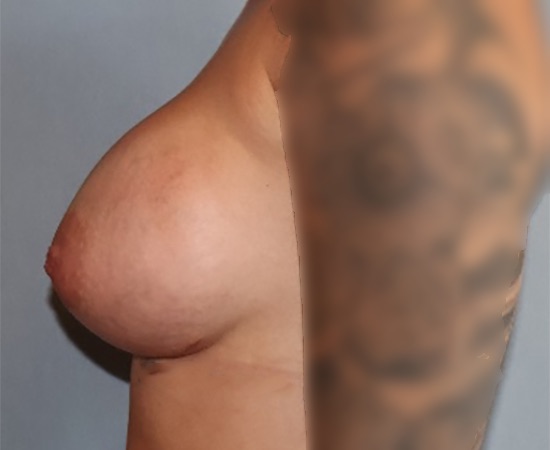 Breast Augmentation Before & After Image