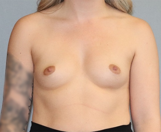 Breast Augmentation Before & After Image