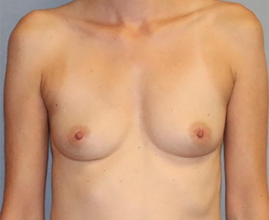 Breast Augmentation Before & After Image