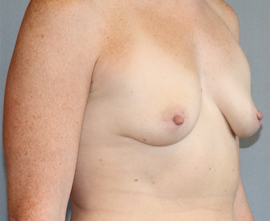 Breast Augmentation Before & After Image