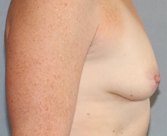 Breast Augmentation Before & After Image