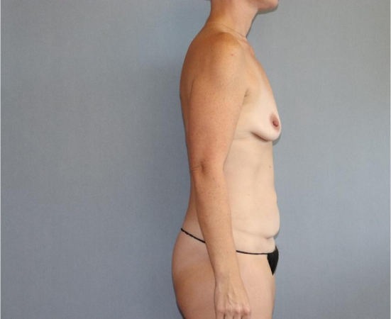 Breast Augmentation Before & After Image