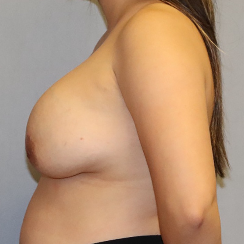 Breast Implant Exchange Before & After Image