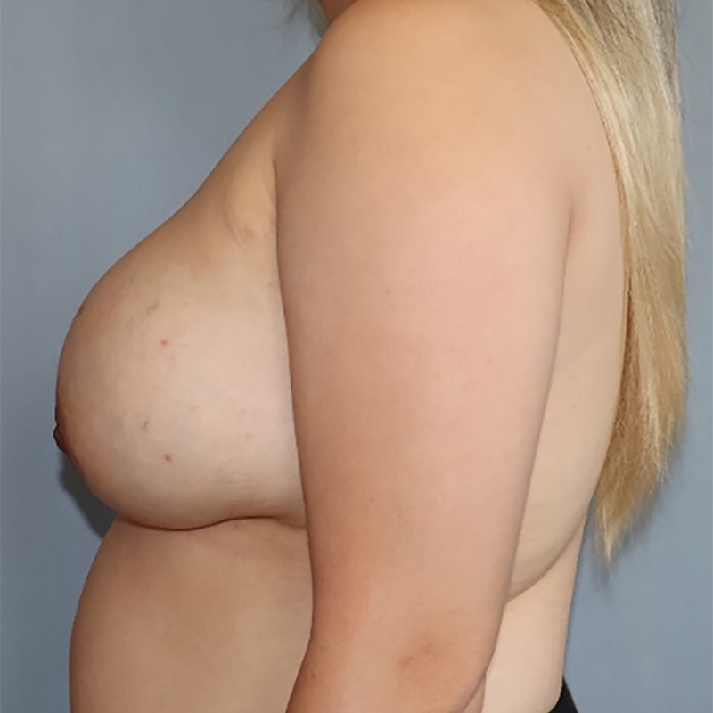 Breast Implant Exchange Before & After Image