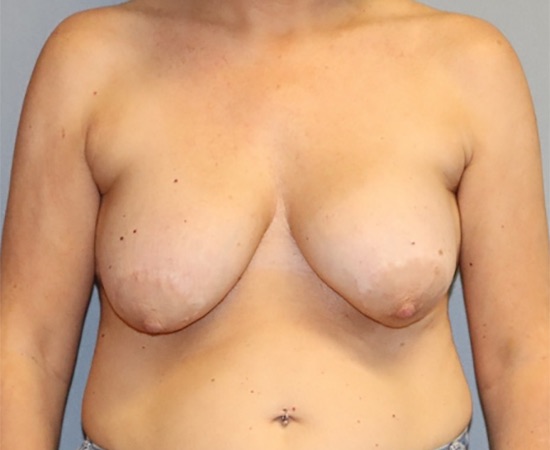 Breast Implant Removal Before & After Image