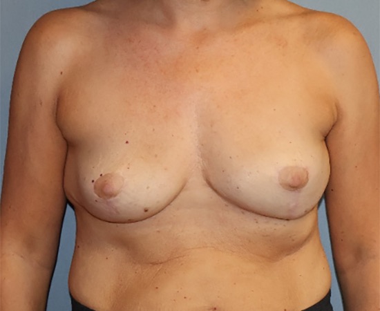 Breast Implant Removal Before & After Image