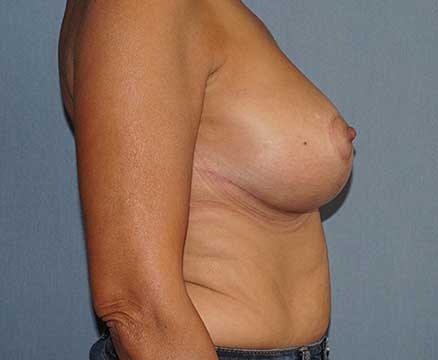 Breast Lift Before & After Image