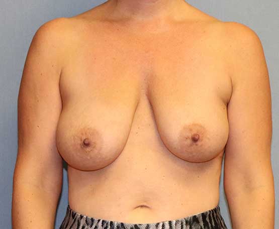 Breast Lift Before & After Image