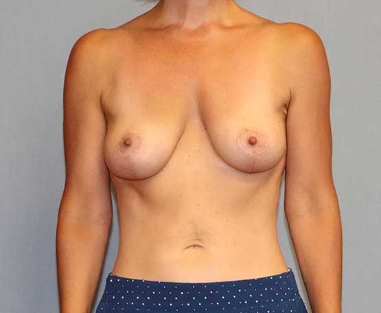 Breast Lift Before & After Image