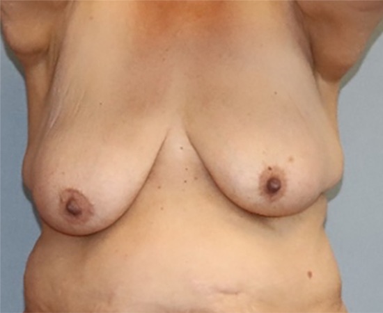 Breast Lift Before & After Image