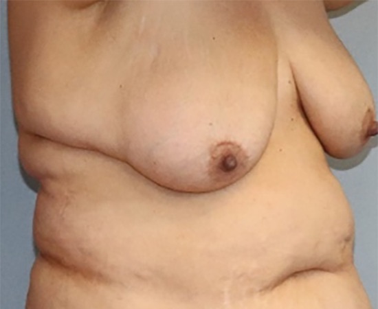 Breast Lift Before & After Image