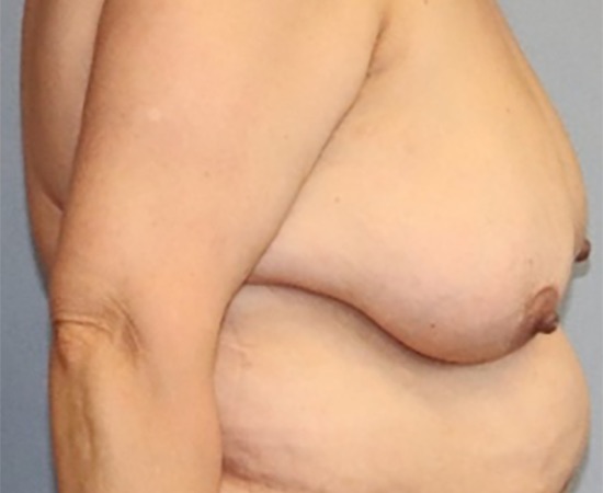 Breast Lift Before & After Image