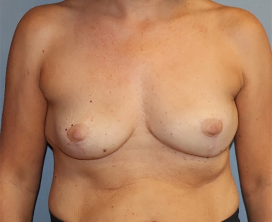 Breast Lift Before & After Image