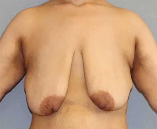 Breast Lift Before & After Image