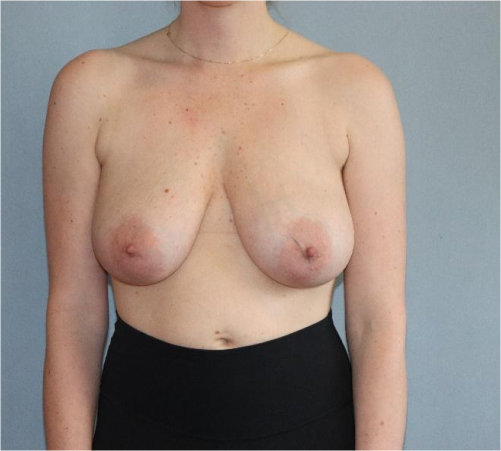 Breast Lift Before & After Image