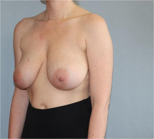 Breast Lift Before & After Image