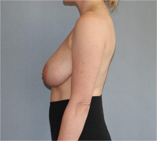 Breast Lift Before & After Image