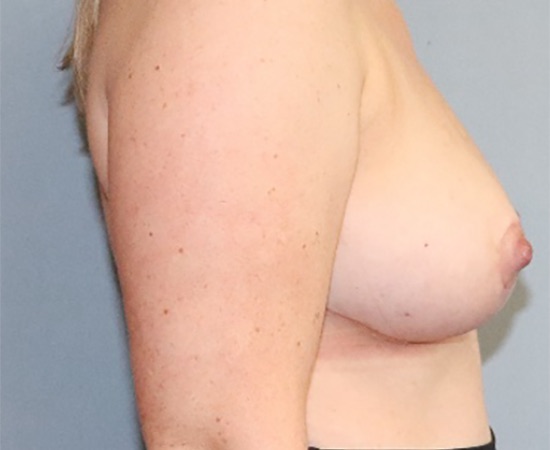 Breast Reduction Before & After Image