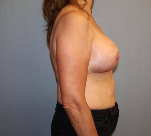 Breast Reduction Before & After Image