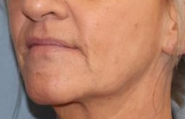 Skinvive Before & After Image