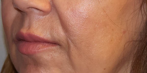 Botox & Fillers Before And After Photo
