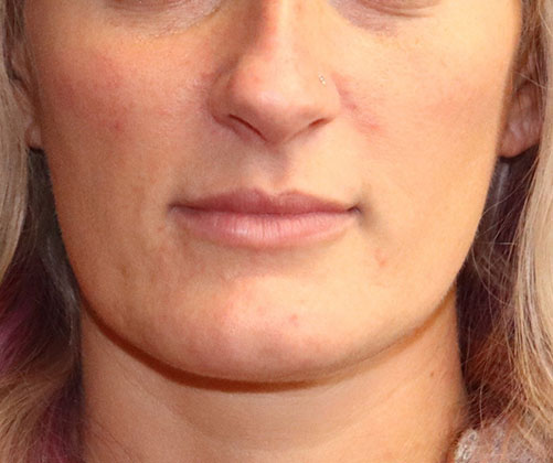 Botox & Fillers Before & After Image