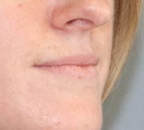 Botox & Fillers Before & After Image