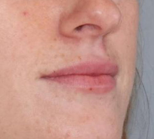 Botox & Fillers Before & After Image