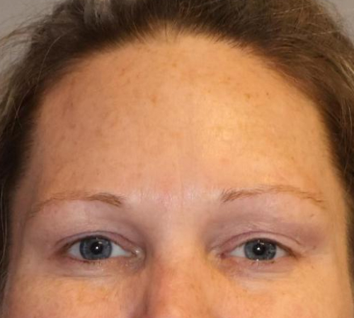 Botox & Fillers Before & After Image