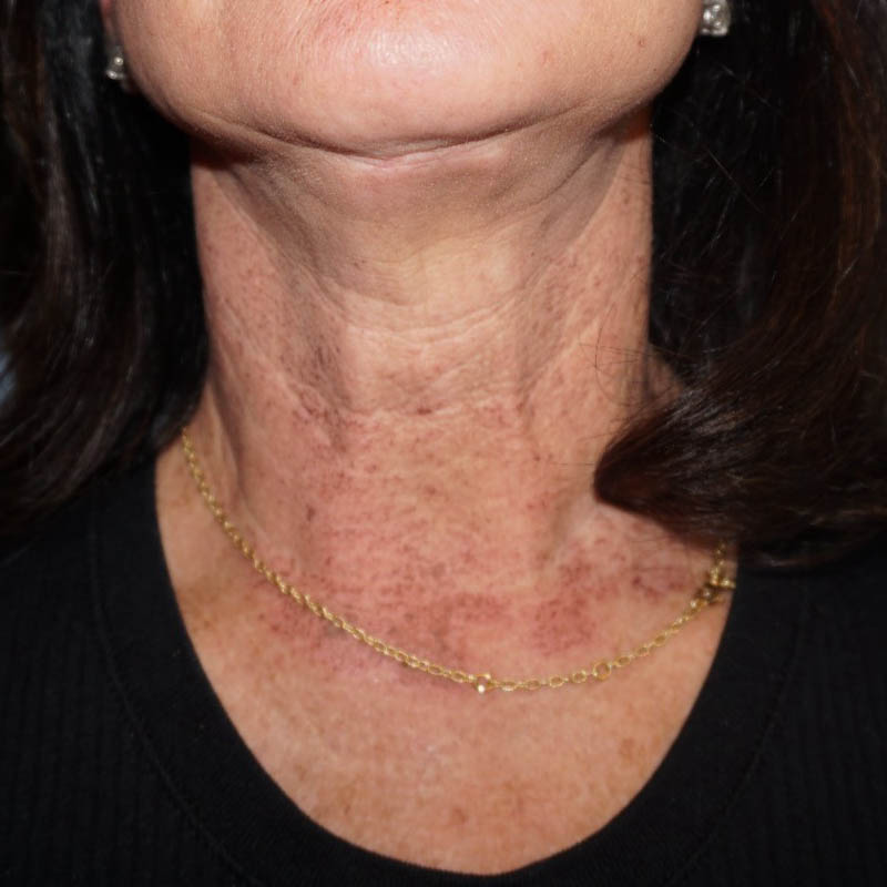 Laser Facial Rejuvenation Before & After Image