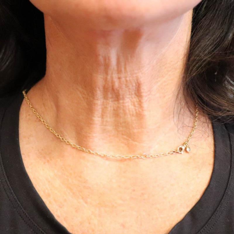 Laser Facial Rejuvenation Before & After Image