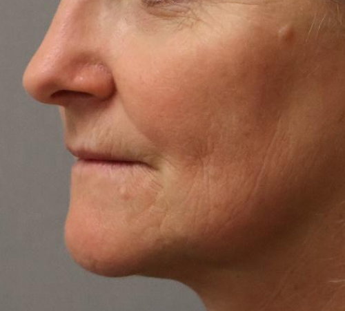 Laser Facial Rejuvenation Before & After Image