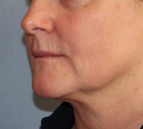 Laser Facial Rejuvenation Before & After Image