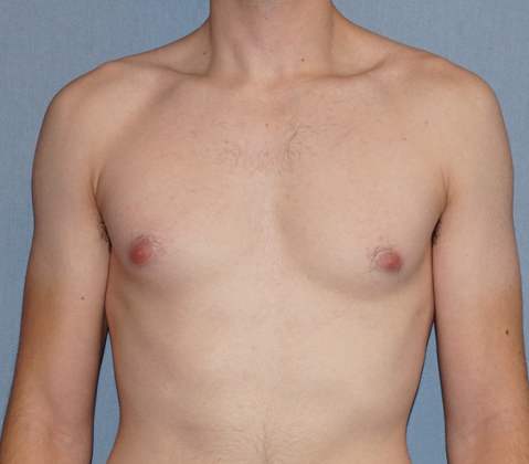 Male Breast Reduction Before & After Image