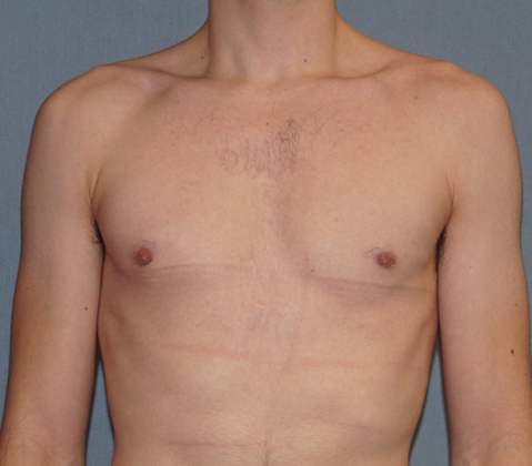 Male Breast Reduction Before And After Patient 8