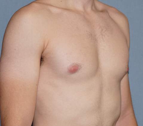 Male Breast Reduction Before & After Image