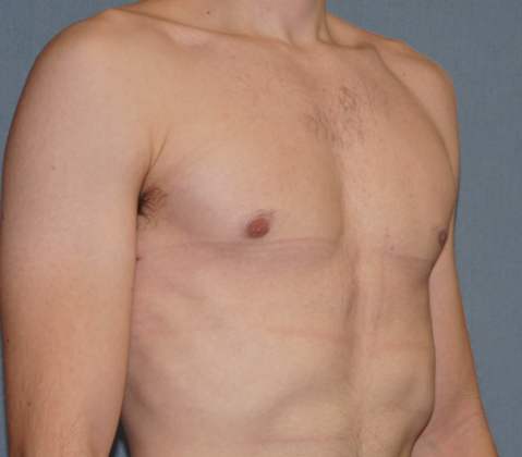 Male Breast Reduction Before & After Image