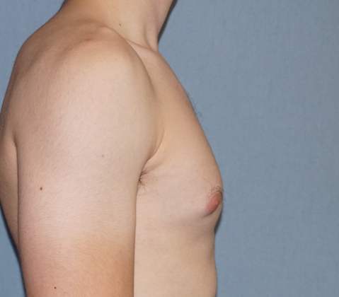 Male Breast Reduction Before & After Image