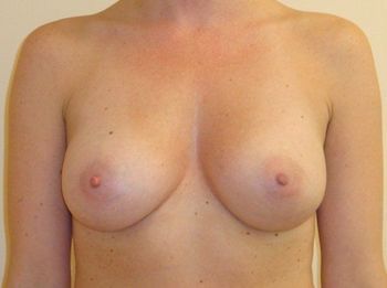 Breast Implants NH